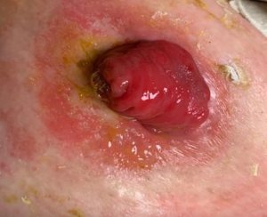 Ostomy Skin Health